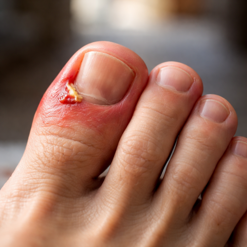 Чому болить великий палець на нозі біля нігтя